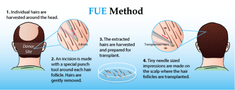 FUE Hair Transplant India