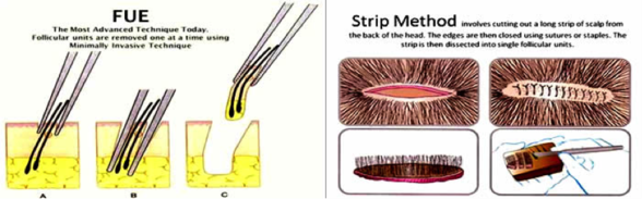 FUE vs FUT comparison chart 