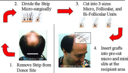 Strip method FUT Hair Transplant
