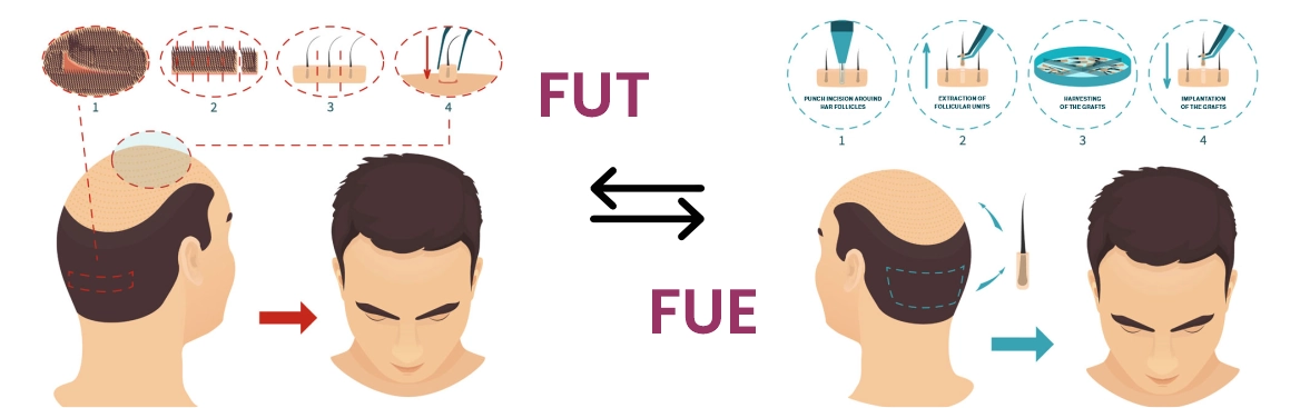 FUE vs FUT comparison chart 