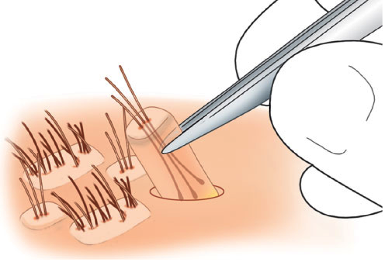 Best Hair Transplant in Ahmedabad - ADORN Dr Harsh Amin Best Hair Transplant in Ahmedabad - ADORN Dr Harsh Amin