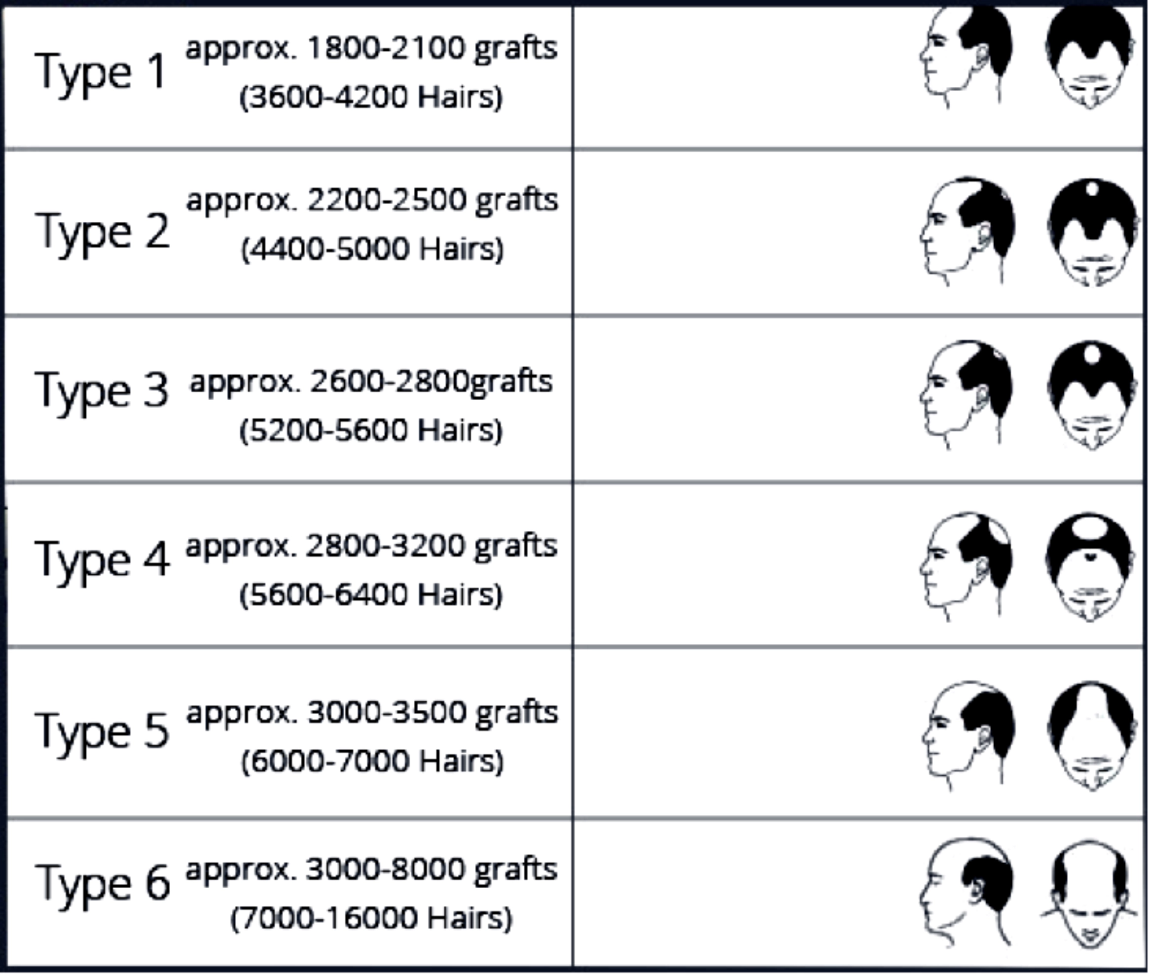 grades of male pattern baldness