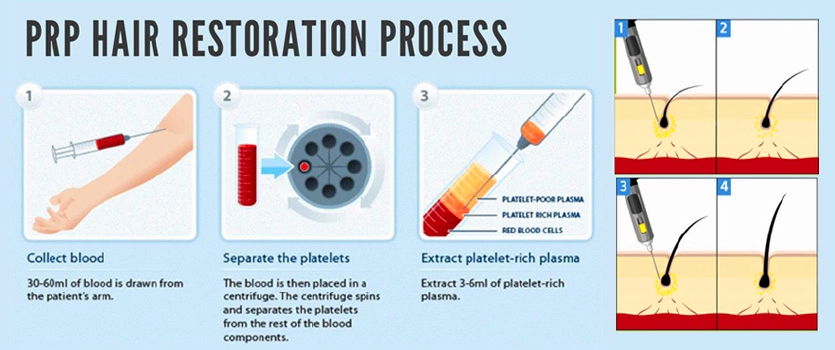 PRP Treatment for Hair Loss