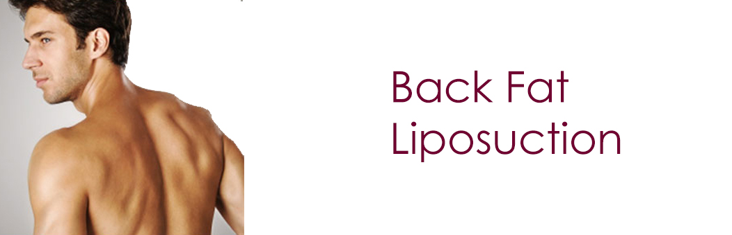back fat liposuction