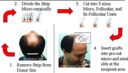 Best Hair Transplant in Ahmedabad - ADORN Dr Harsh Amin Best Hair Transplant in Ahmedabad - ADORN Dr Harsh Amin