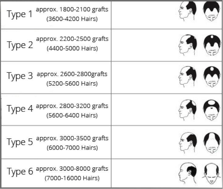 grades of male pattern baldness